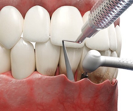 Teeth undergoing pocket reduction treatment