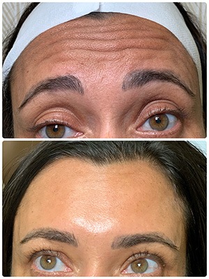 Before and After Dermal Fillers