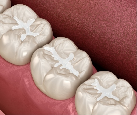 Animated row of teeth with tooth colored fillings from restorative dentist in Vero Beach