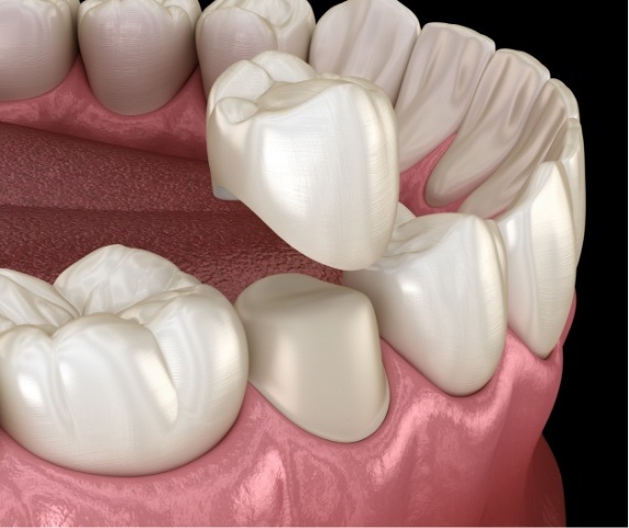 Animated dental crown being placed over tooth