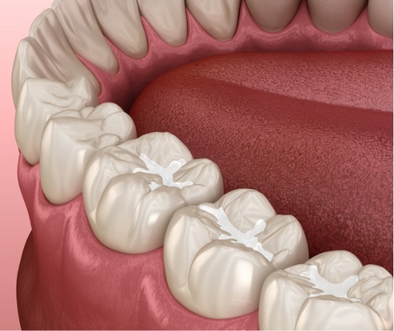 Animated row of teeth with dental sealants