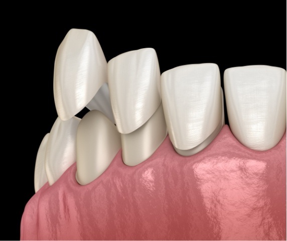 Dental bonding material being placed over a tooth