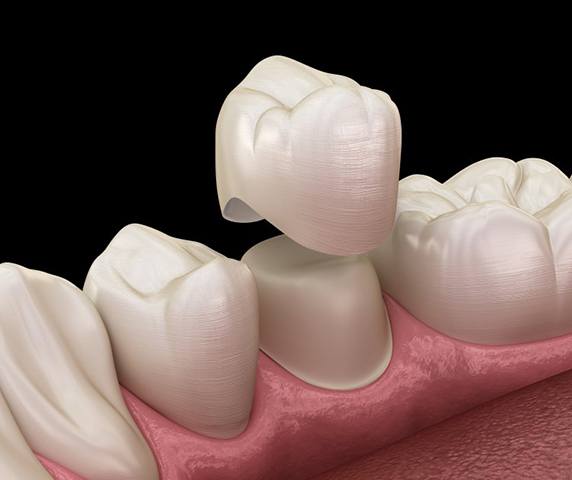 a 3 D illustration of a dental crown