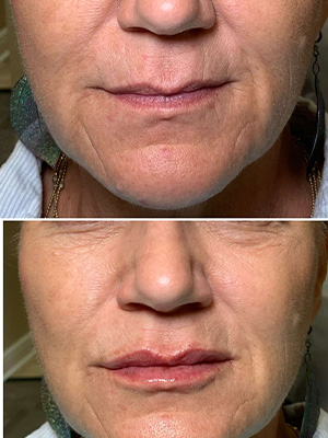 Before and After Dermal Fillers