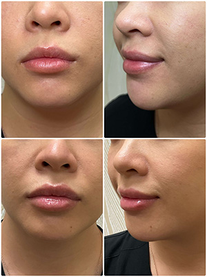 Before and After Dermal Fillers