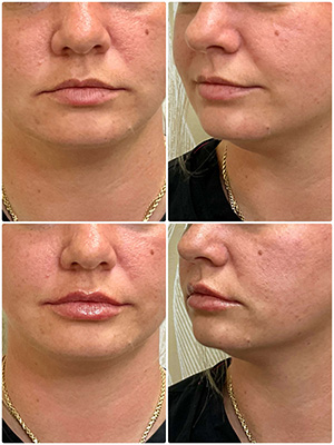 Before and After Dermal Fillers