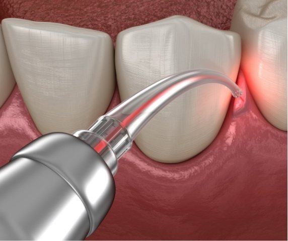 Animated dental laser treating gum disease