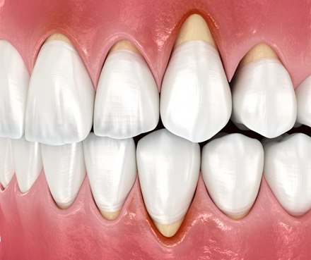 Illustration of receding gums