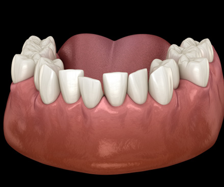 Illustration of crooked teeth