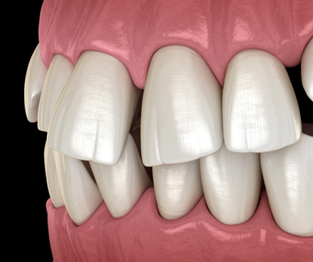 Illustration of gapped teeth