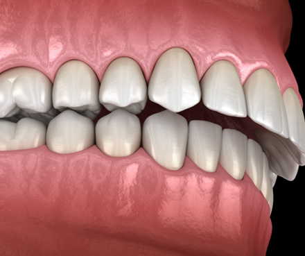 Illustration of an overbite