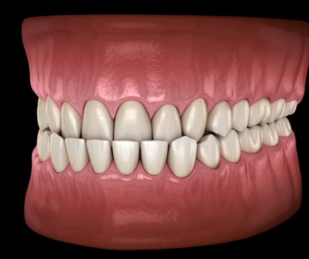Illustration of an underbite