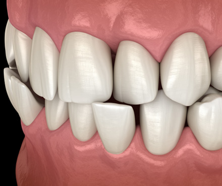 Illustration of a crossbite