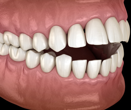 Illustration of an open bite