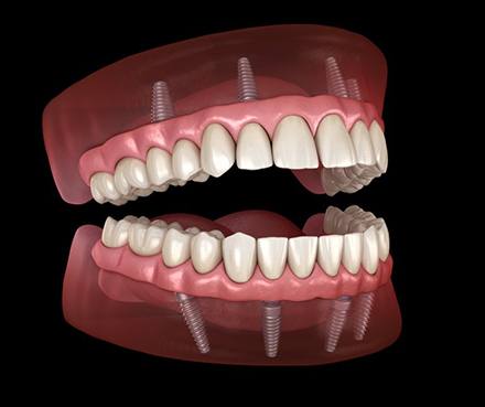Illustration of implant dentures