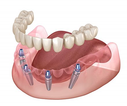 Exploded illustration of implant dentures