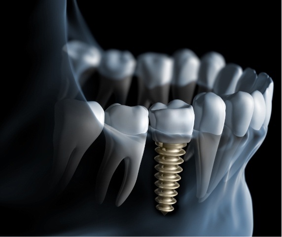 Animated X ray of a person with a dental implant in Vero Beach