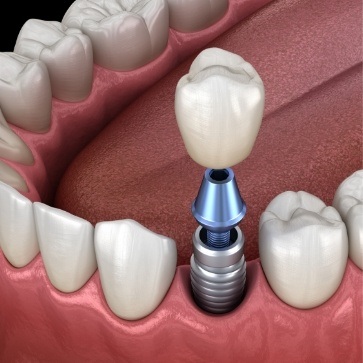 Dental implant with crown replacing single missing tooth