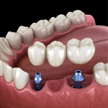 Two dental implants with dental bridge replacing three missing teeth
