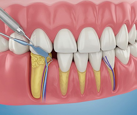A CGI image of scaling and root planing treatment