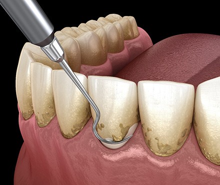 A CGI image of teeth that need scaling and root planing