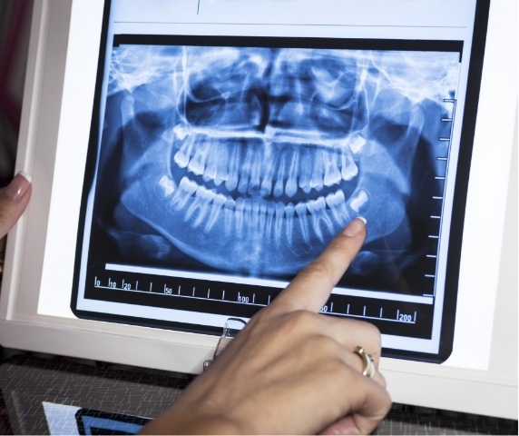 Person pointing to all digital dental x ray of teeth