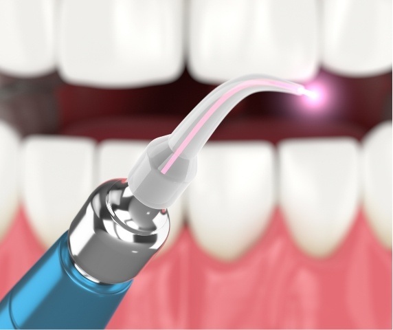 Dental soft tissue laser