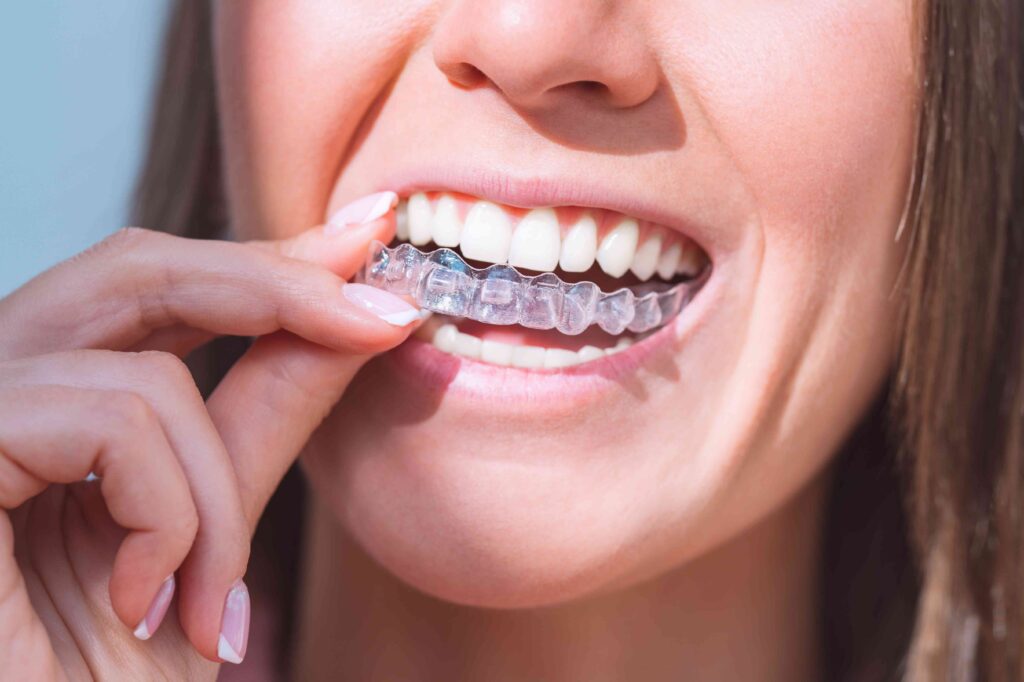 Woman putting in Invisalign aligners