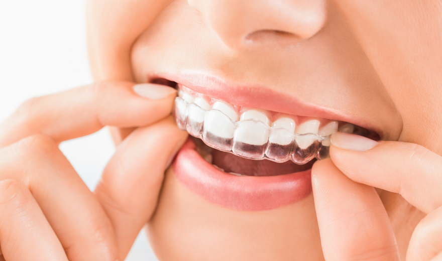 Woman fitting clear aligner