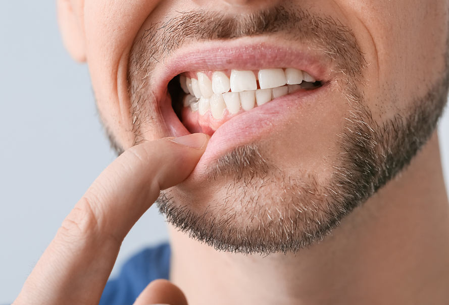 Man pulling at corner of mouth to show gums
